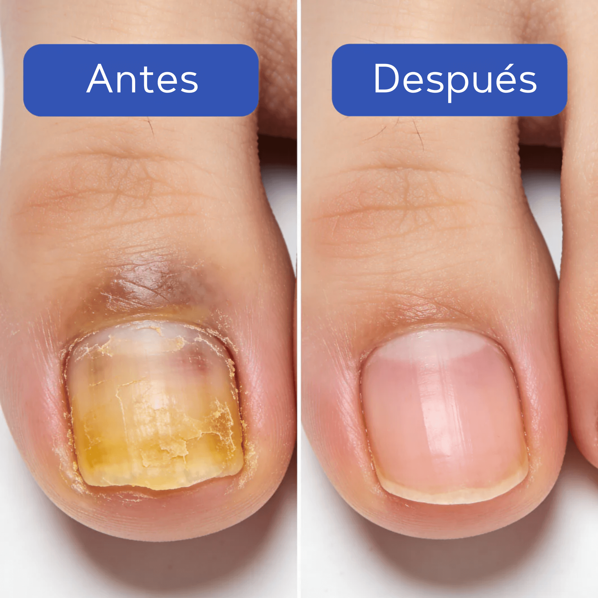 FungixPatch™ Tratamiento antifúngico avanzado