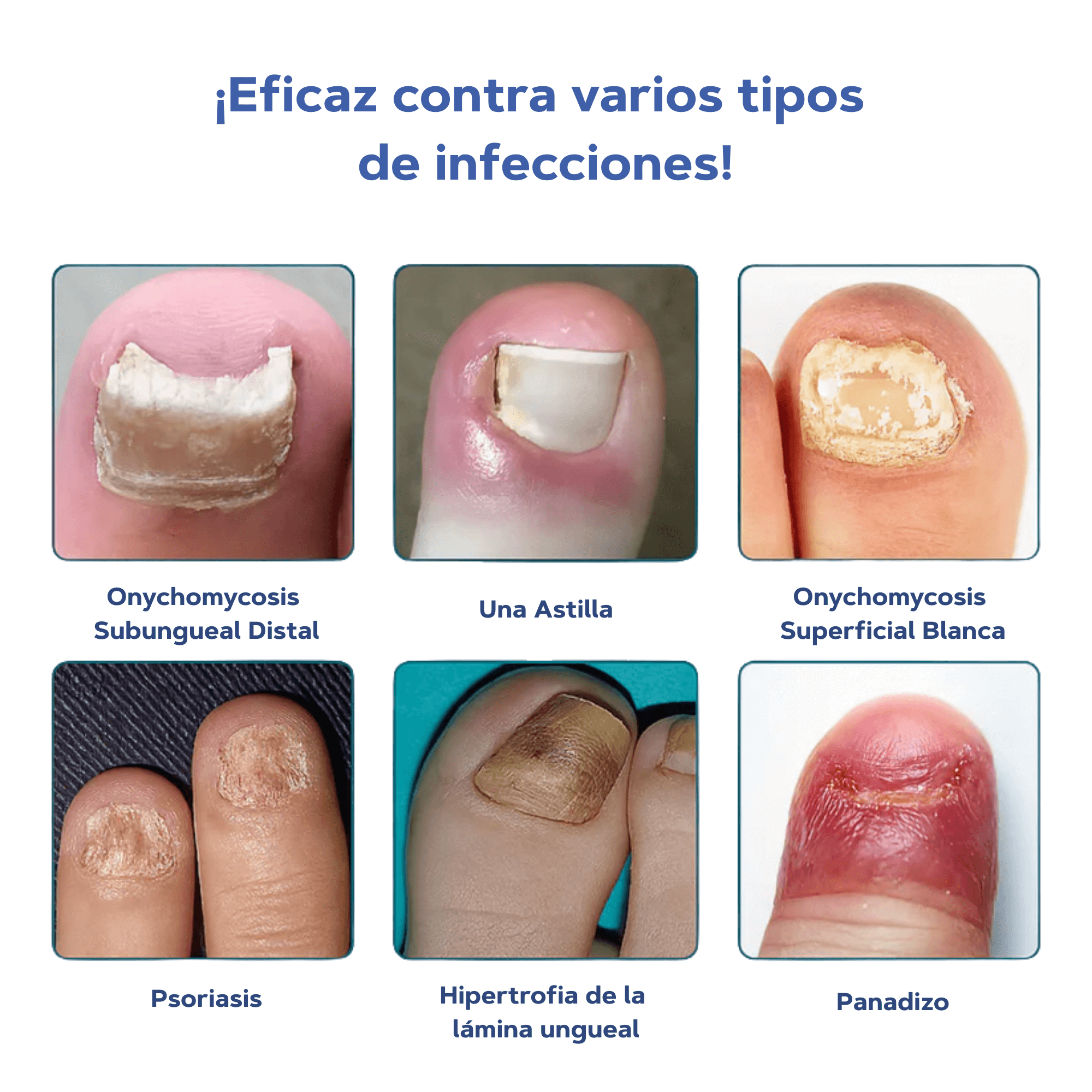 FungixPatch™ Tratamiento antifúngico avanzado